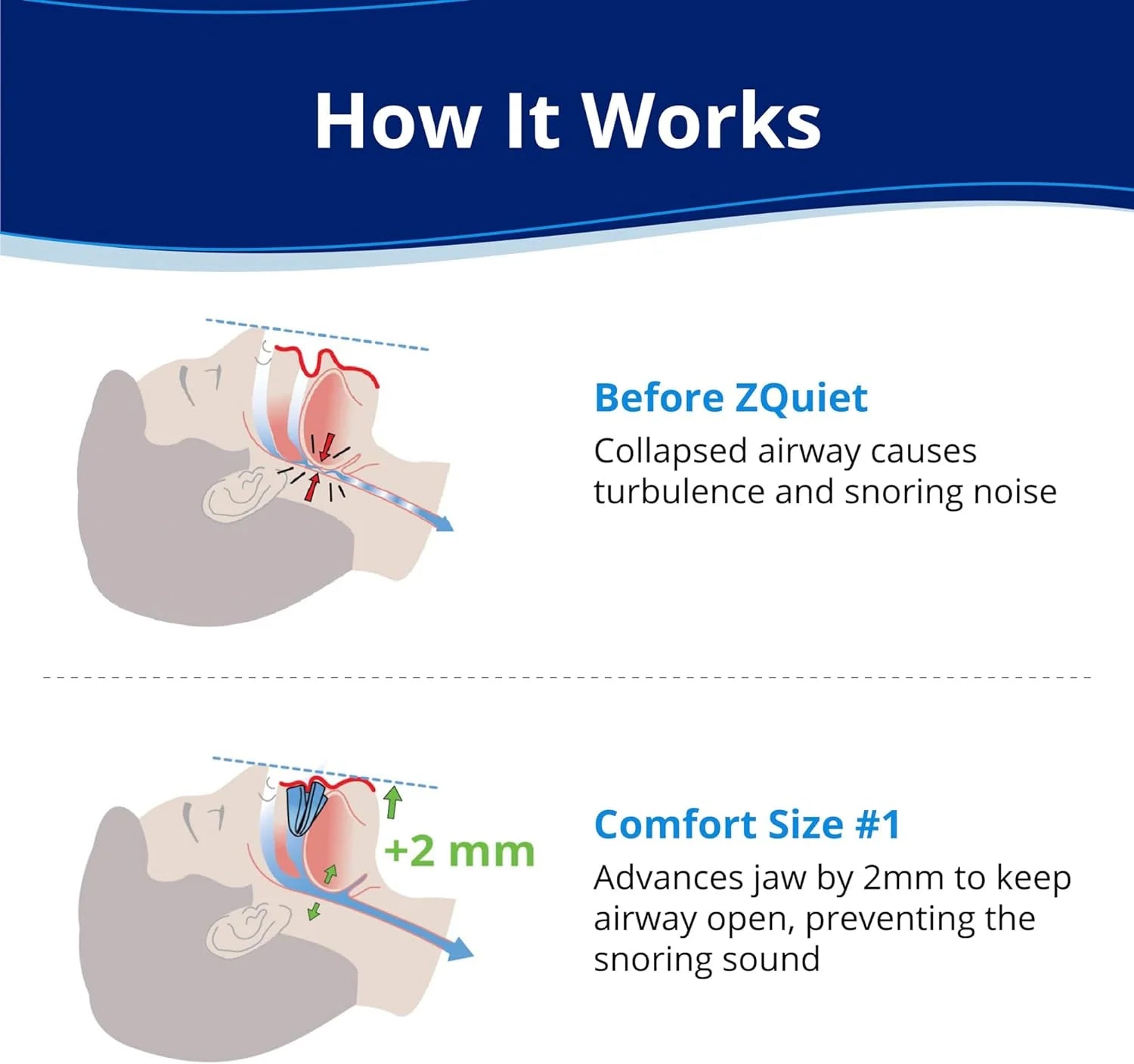 Anti-Snoring Mouthpiece, Comfort Size #1, Single Refill, Blue, BPA-Free, Medical-Grade Material(Blue)